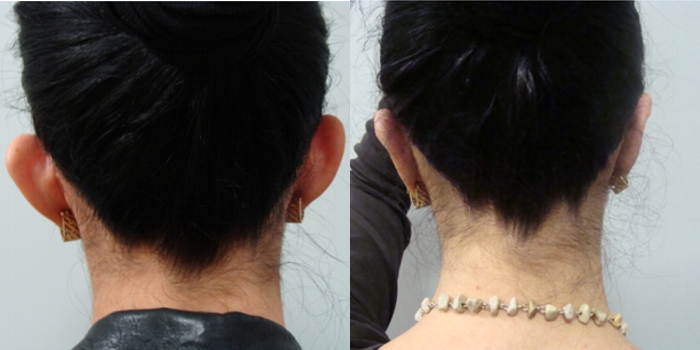 Otoplasty, after a month